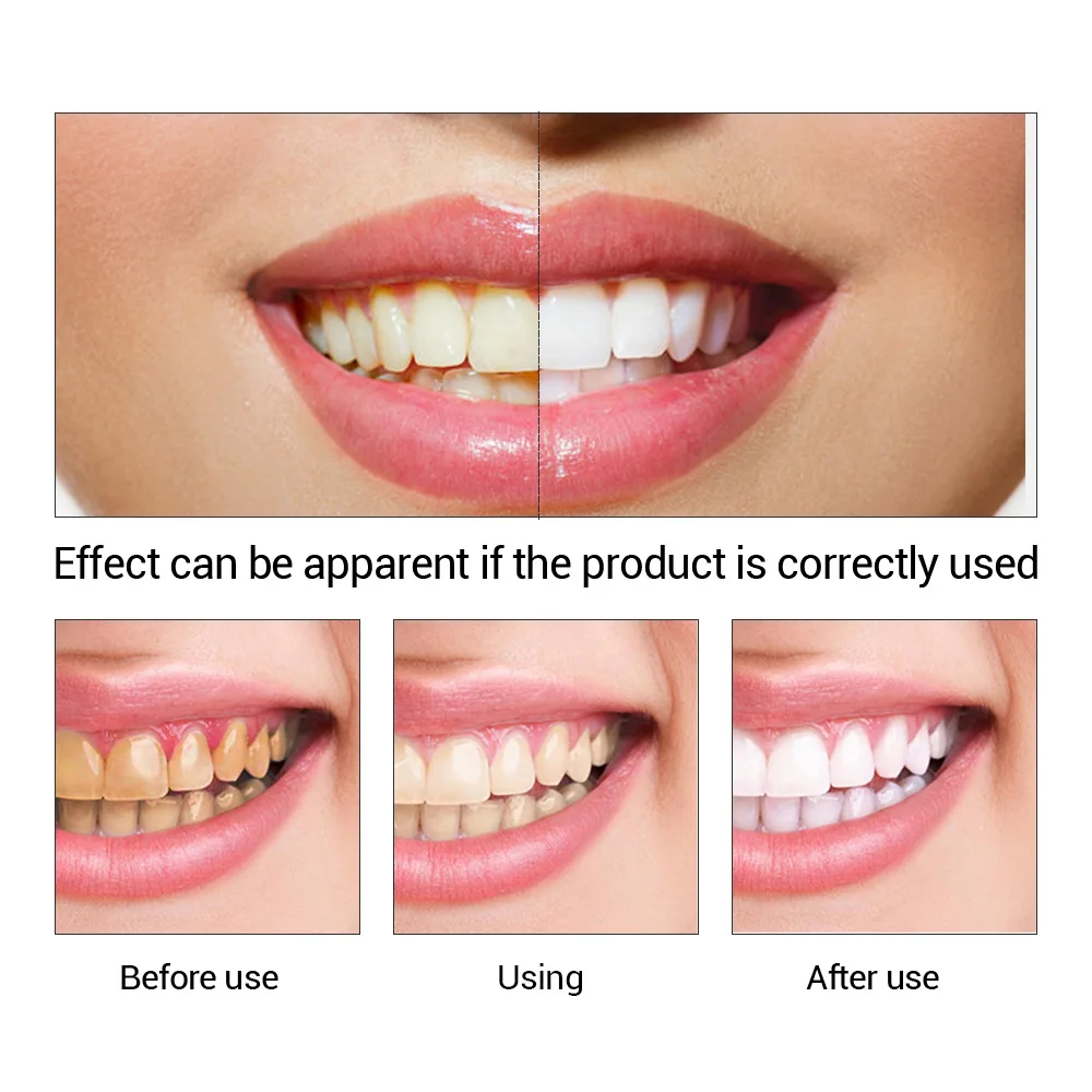 FTEENPLY Teeth Whitening Essen - Teeth Whitening Near Me ulasan dan harga