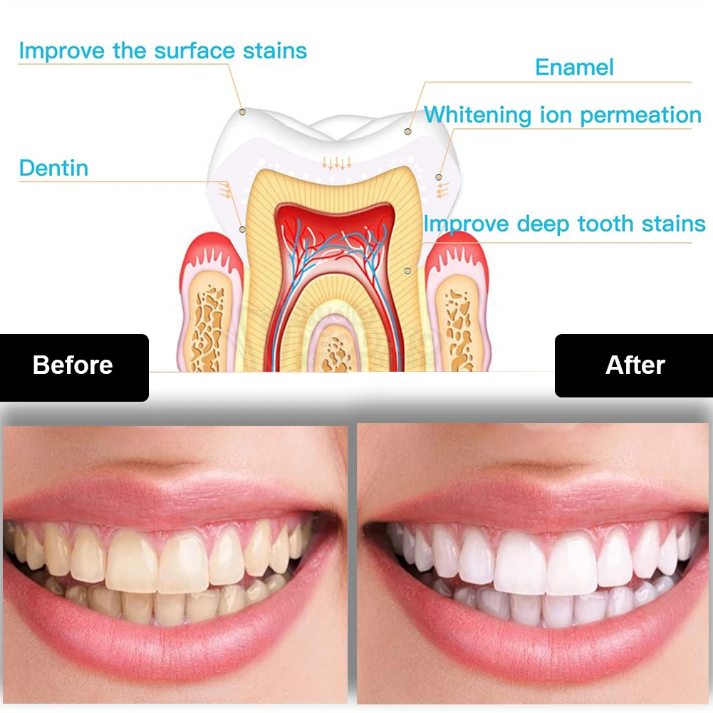 Dental Teeth Whitening Kit Min - Teeth Whitening Light Kit ulasan dan harga